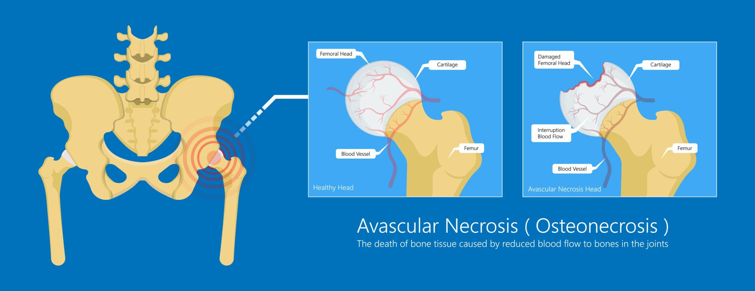 Perthes Disease Later Management in Adults