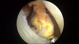 Surgical image showing PVNS in the hip