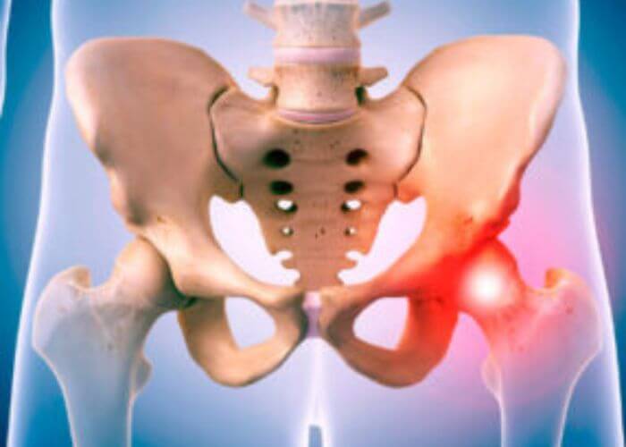 Image showing the hip condition PVNS