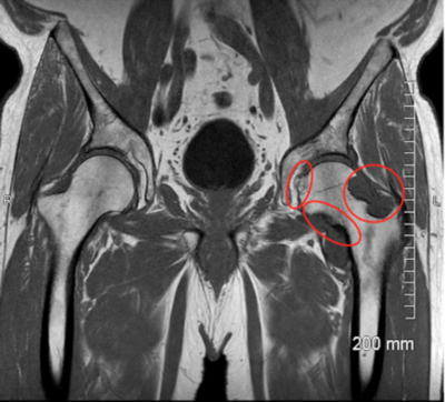 MRI image showing chondromatosis in the left hip