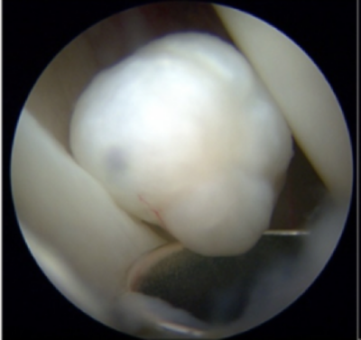 Surgical image showing chondromatosis in the hip