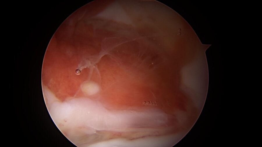 Surgical image showing PVNS in the hip before debridement