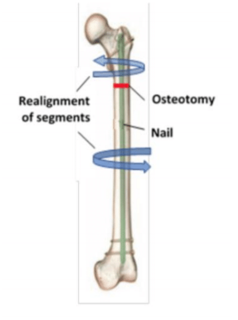 Diagram illustrating proximal femoral derotation