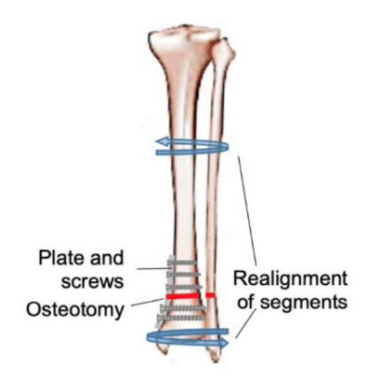 Diagram illustrating distal tibial derotation