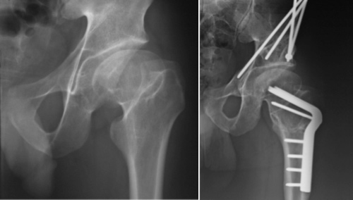 X-ray image demonstrating periacetabular osteotomy (PAO)