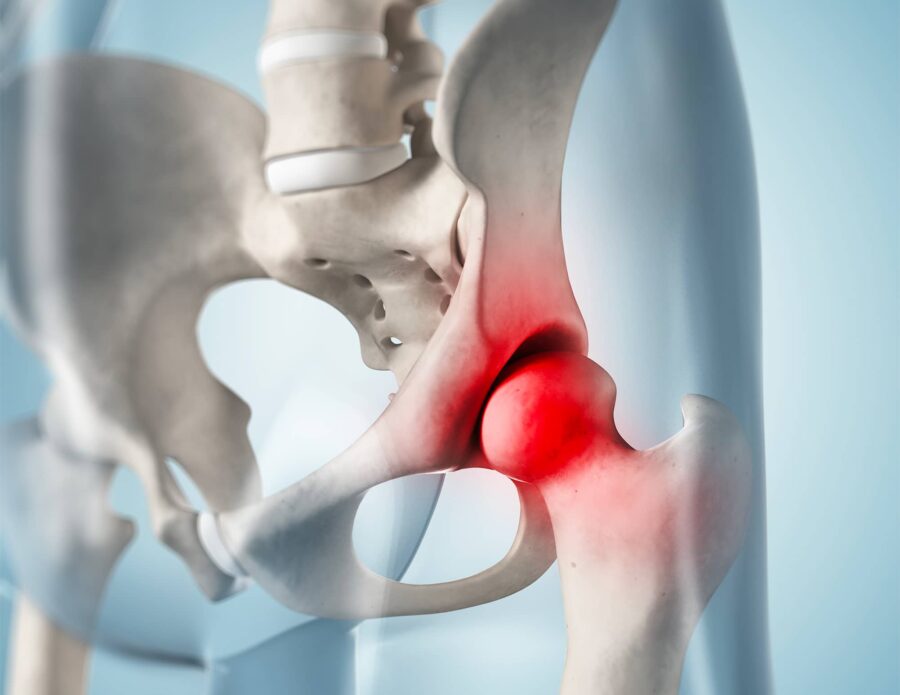 Image showing the pathology of hip chondromatosis